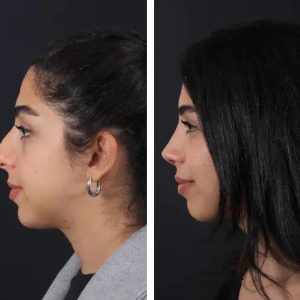 Before-After-Nose-job-4.jpg
