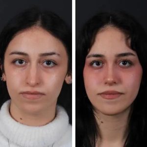 Before-After-Nose-job-8.jpg