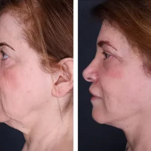 face-lift-before-after-20231018123506.webp