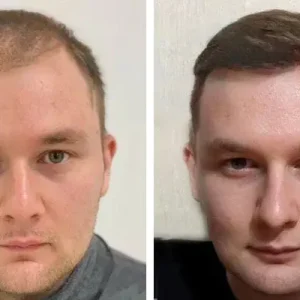 hair-transplant-before-after-20230702224508.webp