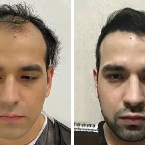 hair-transplant-before-after-20230702225228.webp
