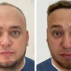 hair-transplant-before-after-20230702225502.webp