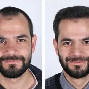 hair-transplant-before-after-20230905113131.webp