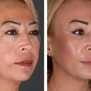 mid-face-lift-before-after-20231019121706.webp