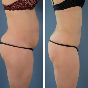 tummy-tuck-before-after-20231021151056.webp