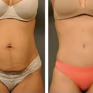 tummy-tuck-before-after-20231107135342.webp