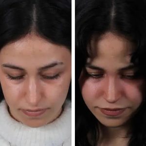 Before-After-Nose-job-9.jpg
