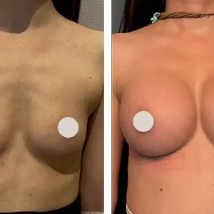 breast-implant-before-after-20231012083230.webp