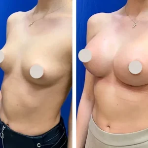 breast-implant-before-after-20231025140009.webp