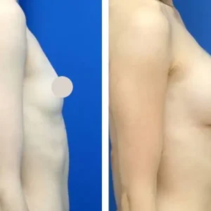 breast-implant-before-after-202310281445141.webp