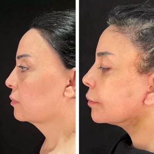 face-lift-before-after-20231016124321.webp