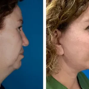 face-lift-before-after-20231105154400.webp
