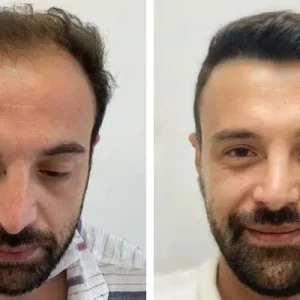 hair-transplant-before-after-20230702224823.webp