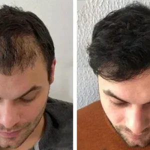 hair-transplant-before-after-20230702225121.webp