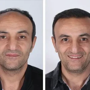hair-transplant-before-after-20230905113246.webp