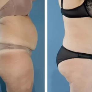 tummy-tuck-before-after-20231021151132.webp