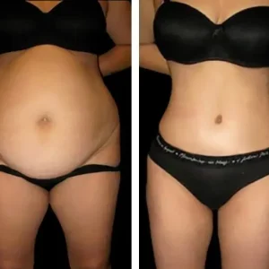 tummy-tuck-before-after-20231022144005.webp