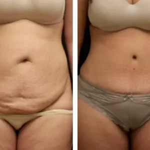 tummy-tuck-before-after-20231110122403.webp