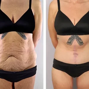 tummy-tuck-before-after-20231122111824.webp