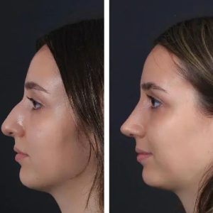 Before After Nose job (2)