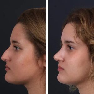Before After Nose job (3)