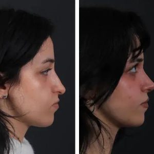 Before After Nose job (5)