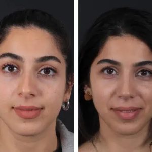 Before After Nose job (6)
