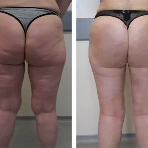 bbl-before-after-202310251002171