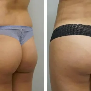 bbl-before-after-20231031234016