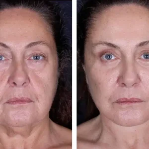 face-lift-before-after-20231018124031