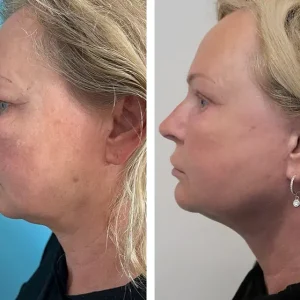 face-lift-before-after-20231025103325