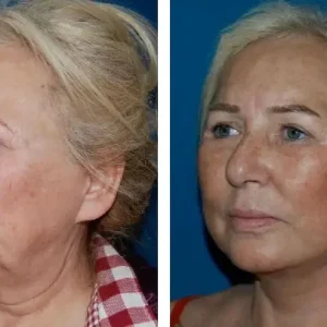 face-lift-before-after-20231105154713