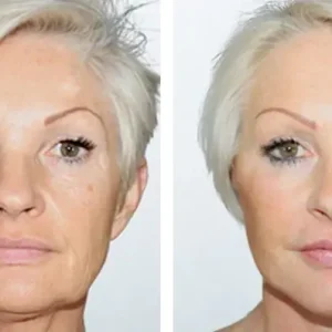 face-lift-before-after-20231122111335