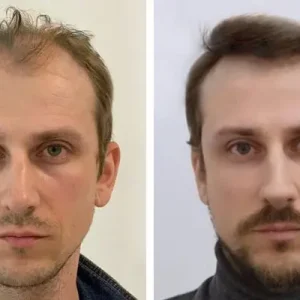 hair-transplant-before-after-20230702223958