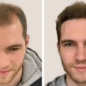 hair-transplant-before-after-20230702224729