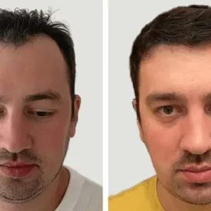 hair-transplant-before-after-20230702225350