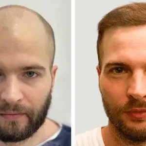 hair-transplant-before-after-20230702225558