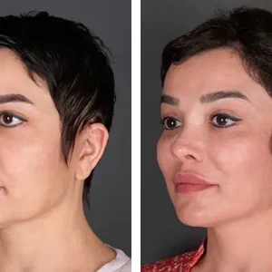 mid-face-lift-before-after-20231019121345