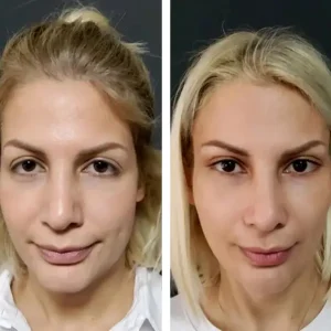 midface-lift-before-after-20231107121544