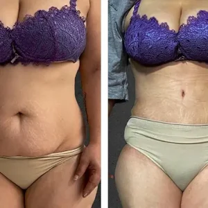 tummy-tuck-before-after-20231012090335