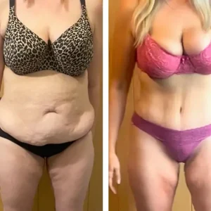 tummy-tuck-before-after-20231122112007